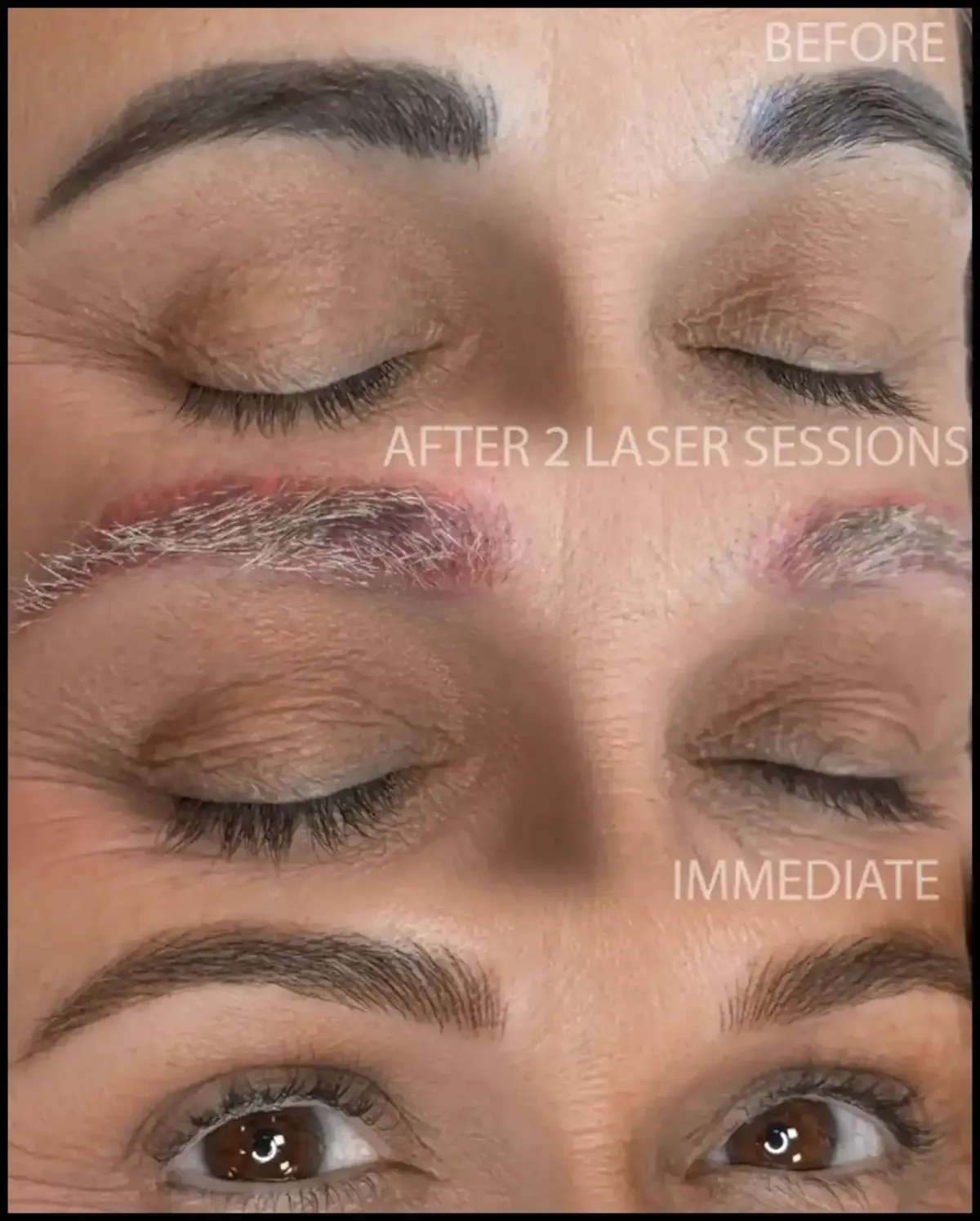 Brow correction before and after treatment